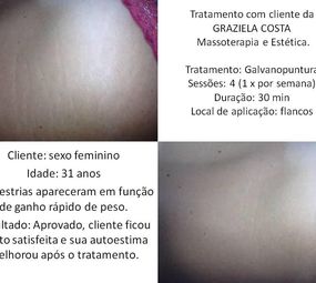 Tratamento para estrias.